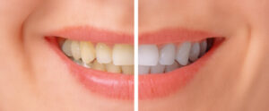 teeth whitening