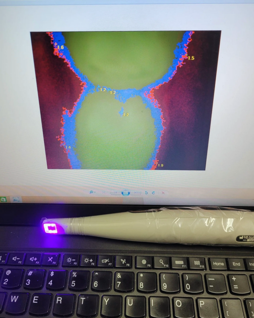 Spectra Caries Detection