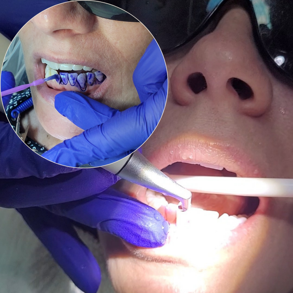 Biofilm Removal