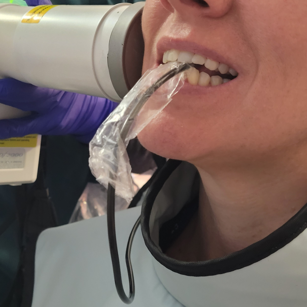  Digital X-Rays We use low dose digital x-rays for our clients with lead apron and thyroid collar for extra protection. If you use homeopathy you can take 3 pellets under the tongue after to reduce your body's absorption of radiation. Caries Detection without X-Rays