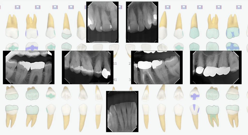 Digital X-rays